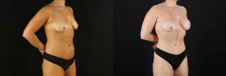 Mommy Makeover case #6516