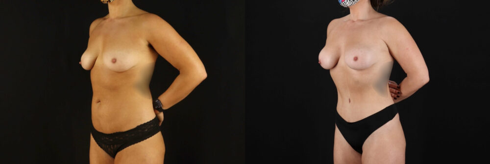 Mommy Makeover case #6516