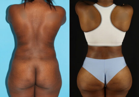 Tummy Tuck case #7277