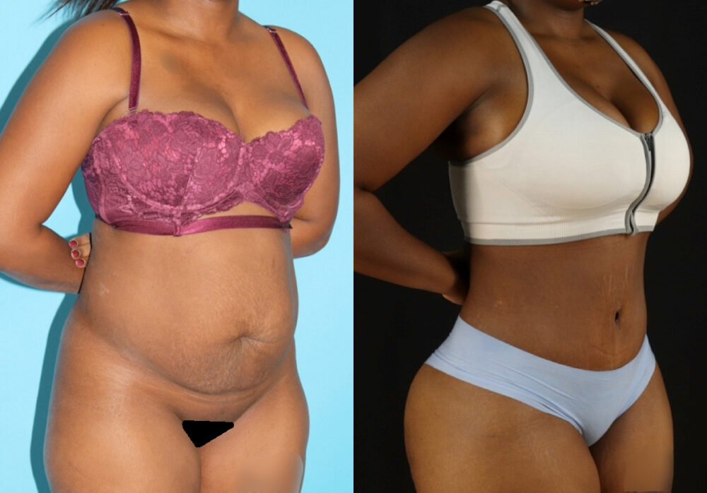 Tummy Tuck case #7277
