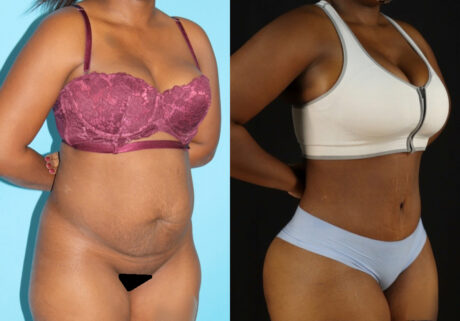 Tummy Tuck case #7277
