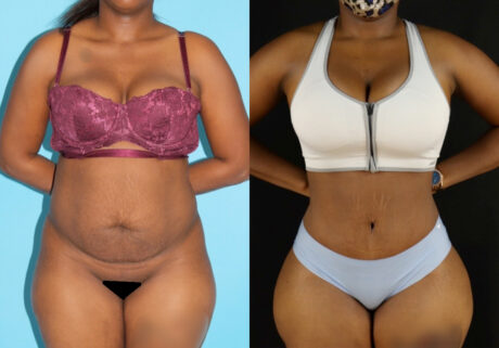 Tummy Tuck case #7277