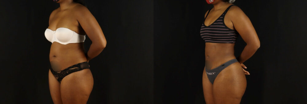 Brazilian Butt Lift case #5172