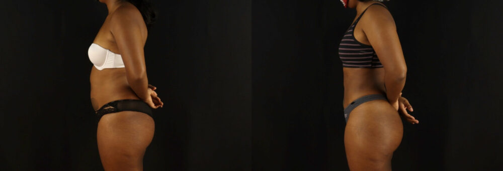 Brazilian Butt Lift case #5172