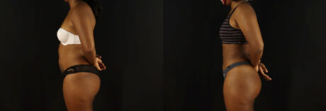 Brazilian Butt Lift case #5172