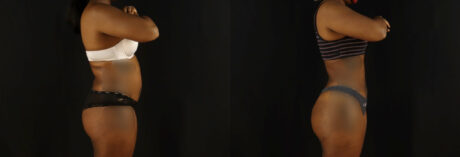 Brazilian Butt Lift case #5172