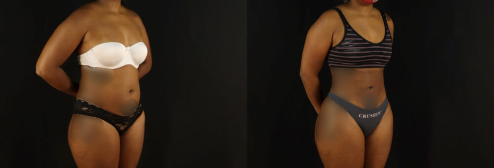 Brazilian Butt Lift case #5172