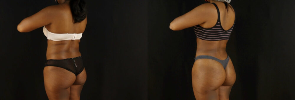 Brazilian Butt Lift case #5172