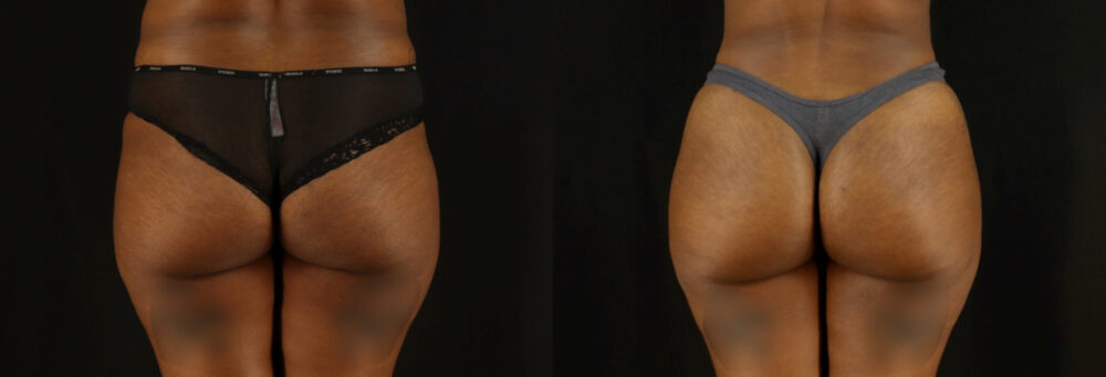 Brazilian Butt Lift case #5172