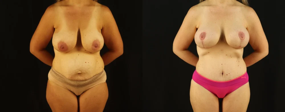 Mommy Makeover case #6517