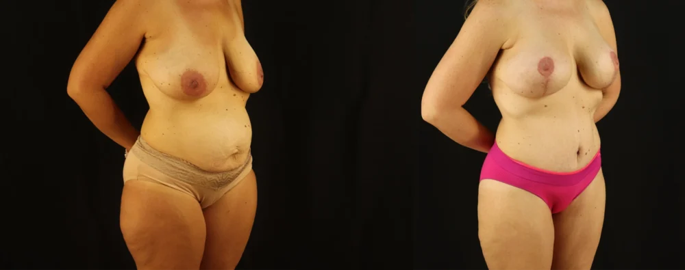 Mommy Makeover case #6517