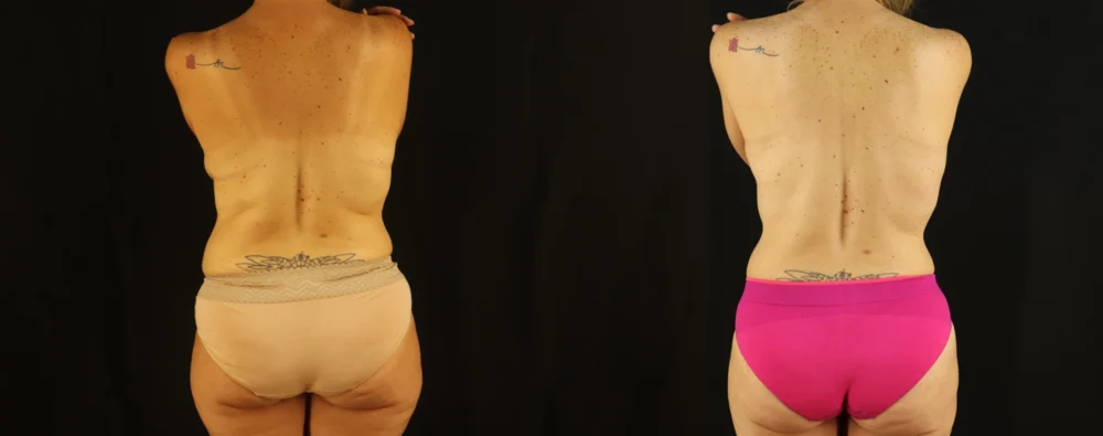 Mommy Makeover case #6517