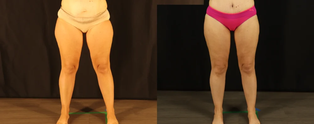 Mommy Makeover case #6517