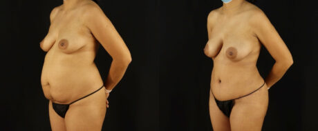 Mommy Makeover case #6518