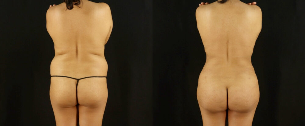 Mommy Makeover case #6518