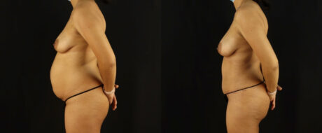 Mommy Makeover case #6518