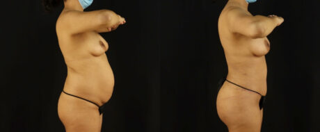 Mommy Makeover case #6518