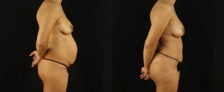 Mommy Makeover case #6518