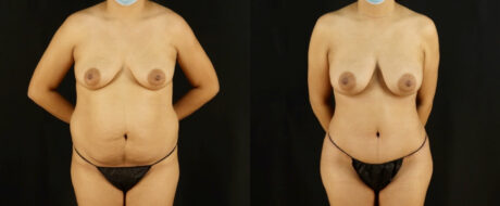 Mommy Makeover case #6518