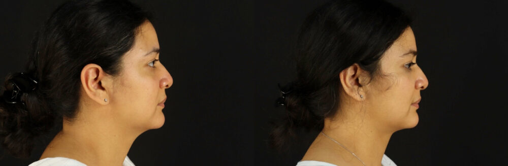 Submental Liposuction case #6947