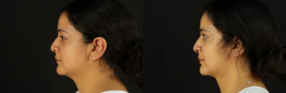 Submental Liposuction case #6947