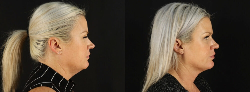 Submental Liposuction case #6948