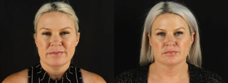 Submental Liposuction case #6948