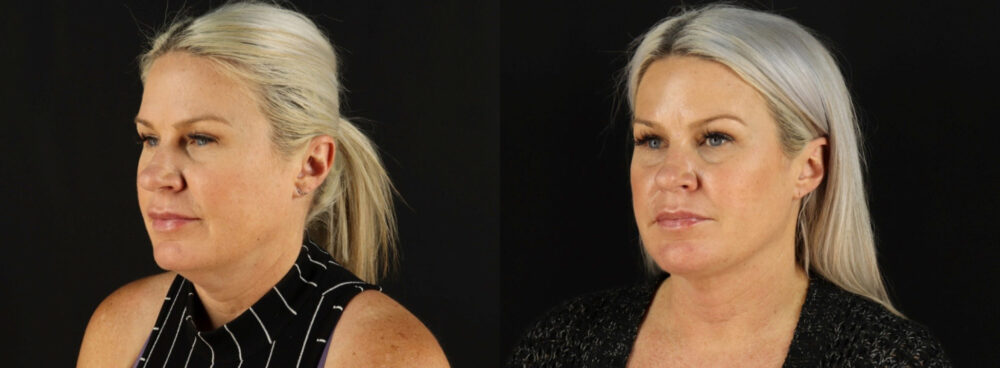 Submental Liposuction case #6948