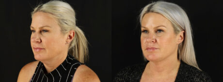 Submental Liposuction case #6948