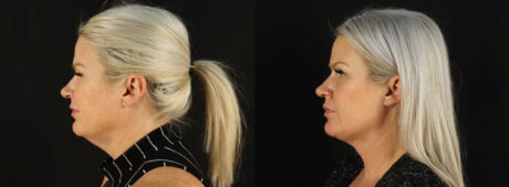 Submental Liposuction case #6948