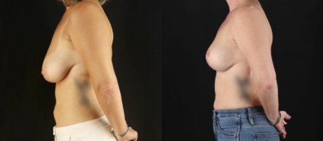 Breast Lift case #7762