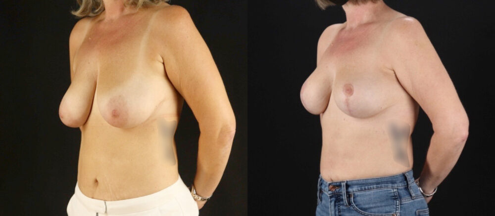 Breast Lift case #7762