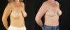 Breast Lift case #7762 slider thumbnail