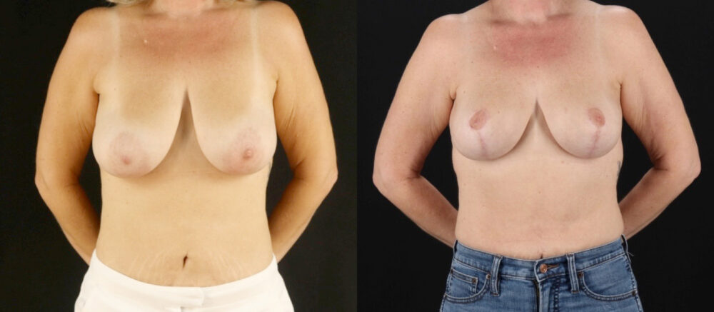 Breast Lift case #7762