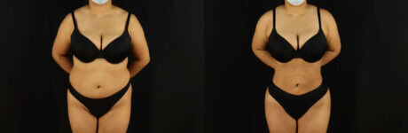 Brazilian Butt Lift case #5173