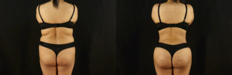 Brazilian Butt Lift case #5173