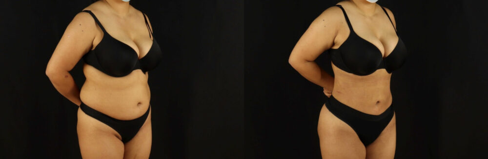 Brazilian Butt Lift case #5173