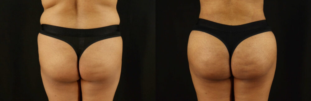 Brazilian Butt Lift case #5173