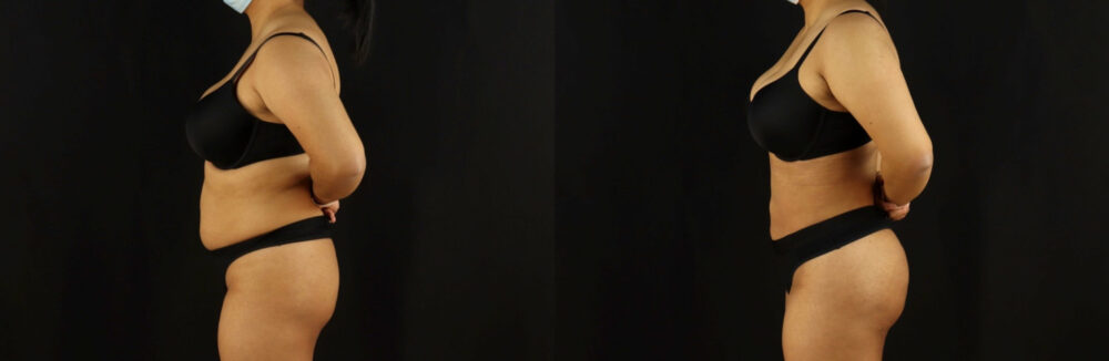 Brazilian Butt Lift case #5173