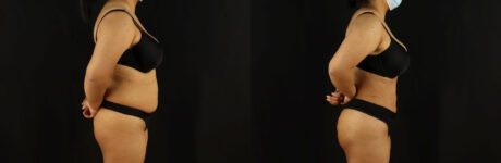 Brazilian Butt Lift case #5173