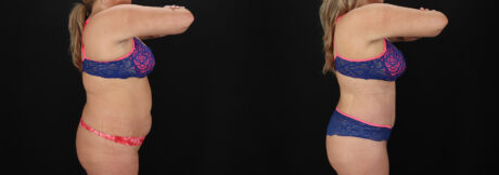 Tummy Tuck case #7775