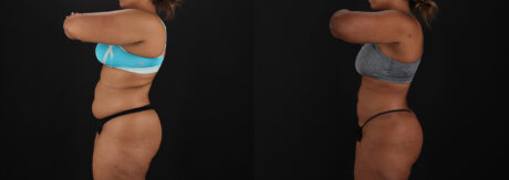 Brazilian Butt Lift case #5513