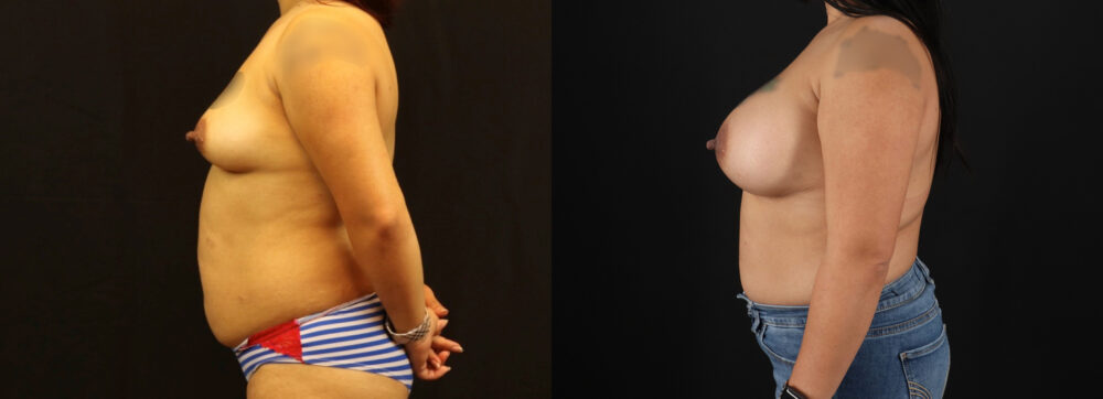 Breast Augmentation case #6384