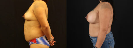 Breast Augmentation case #6384