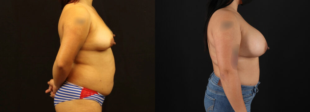 Breast Augmentation case #6384