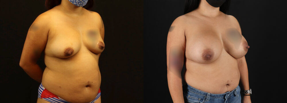 Breast Augmentation case #6384