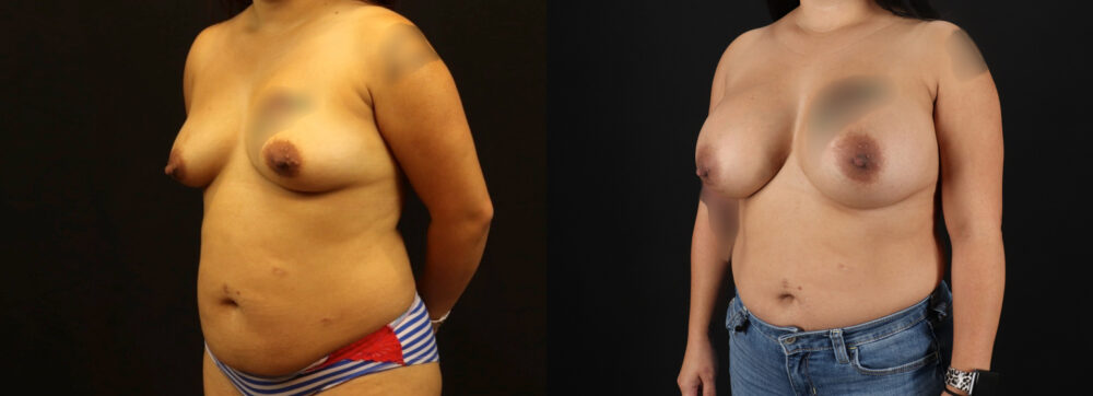 Breast Augmentation case #6384