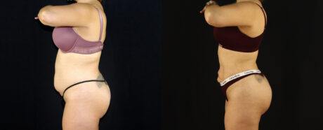 Brazilian Butt Lift case #5174