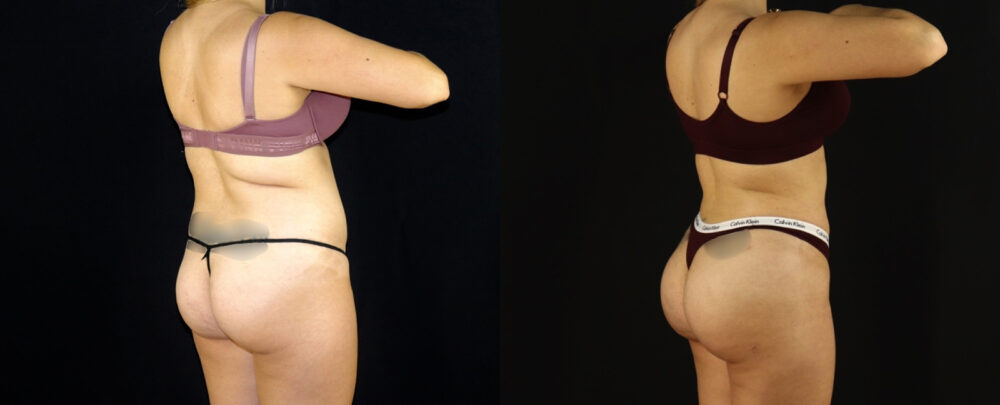 Brazilian Butt Lift case #5174