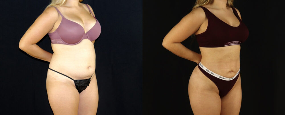 Brazilian Butt Lift case #5174